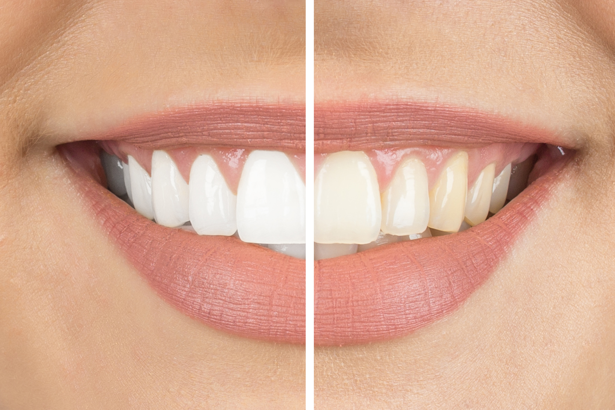 Jak přírodní cestou vybělit zuby?